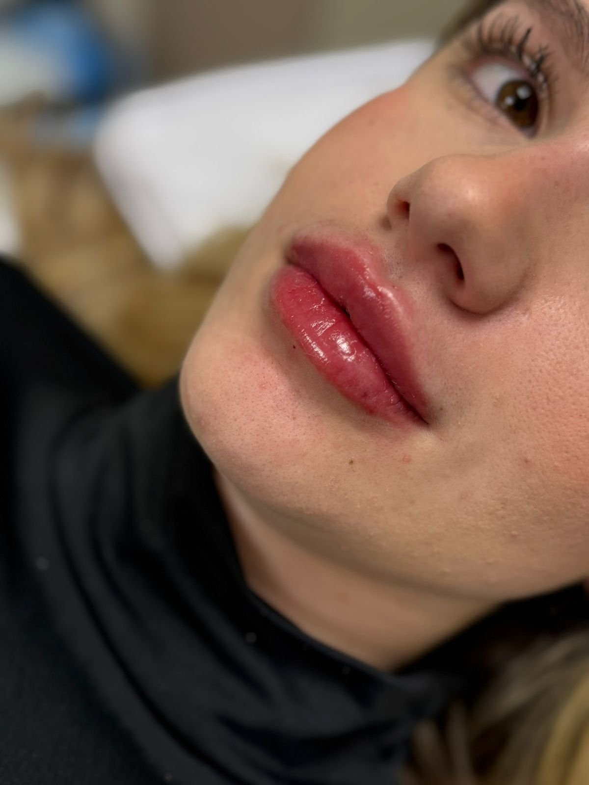 Preenchimento labial natural na clínica de estética AURIÊ no Batel em Curitiba